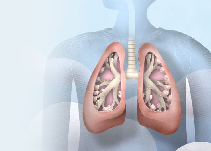 Respiratory Therapy and Rehabilitation